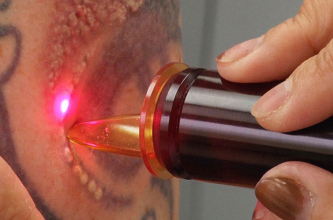 A doctor uses laser equipment to remove a tattoo. - JAMES MUTTER (WIKIMEDIA COMMONS)